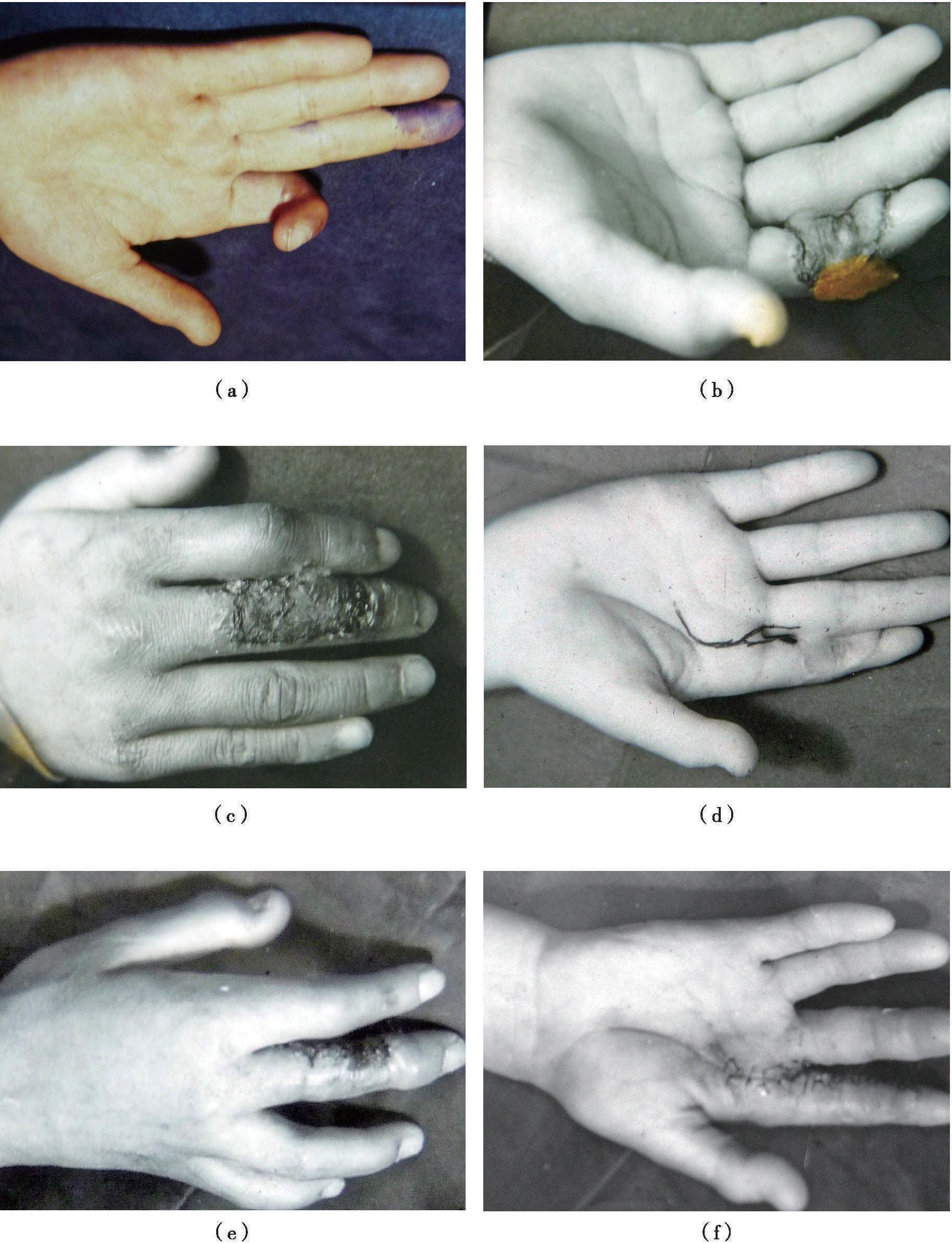 3.2.3 带指背神经邻指皮瓣修复指端和指腹侧创面